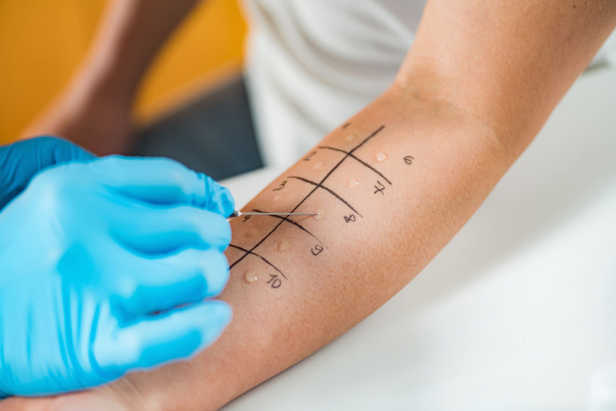Allergy Testing in Singapore
