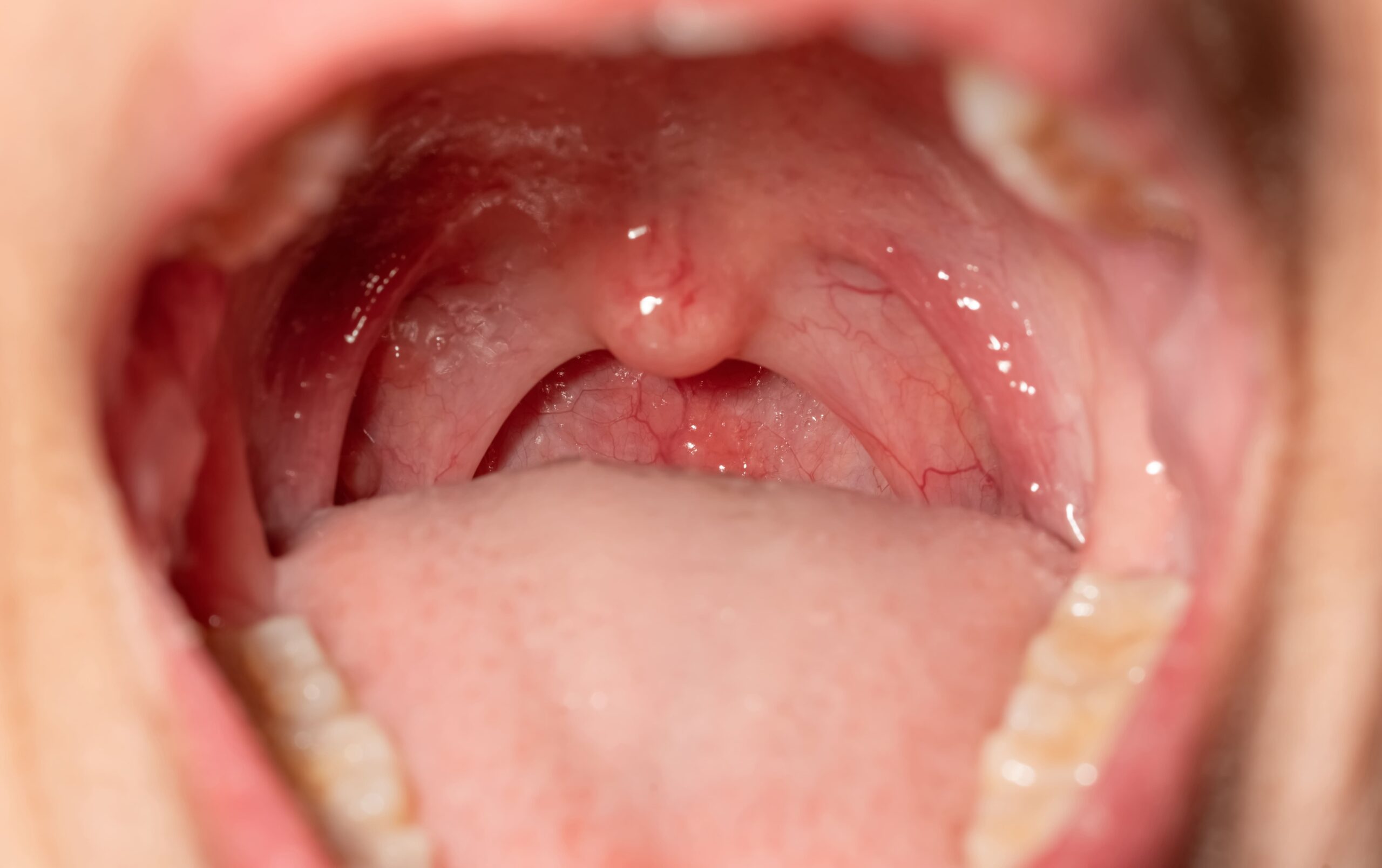 Image enlarged tonsil