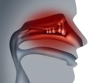 Nasal Polyp Surgery in Singapore